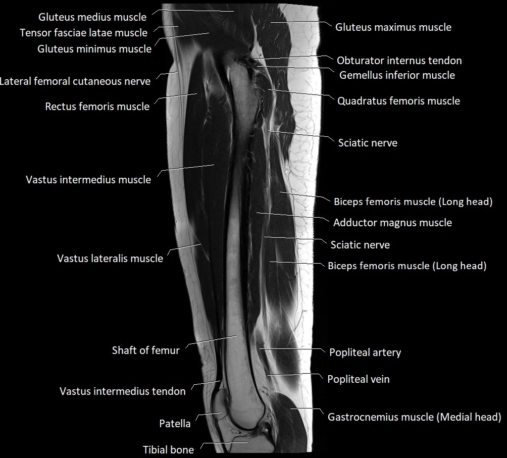 Thigh sagittal cross sectional anatomy MRI 3T image 9.webp
